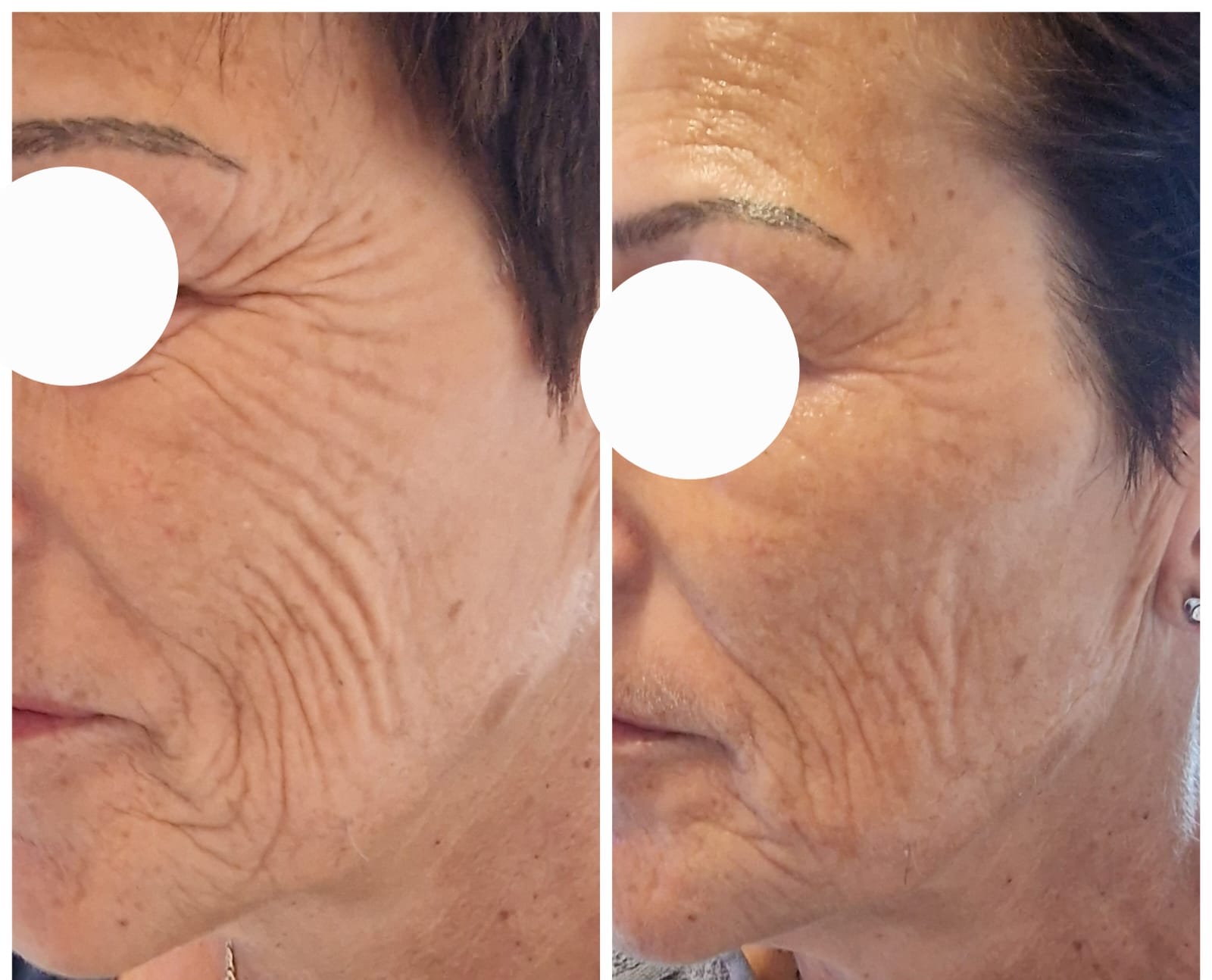 Bio-Microneedling-Ergebnis bei Hautgefühl: links vorher, rechts nachher